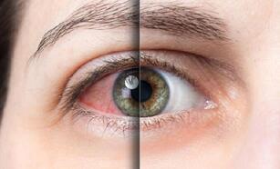 Uzman isim uyardı: Göz alerjisi kornea ülserine yol açabilir