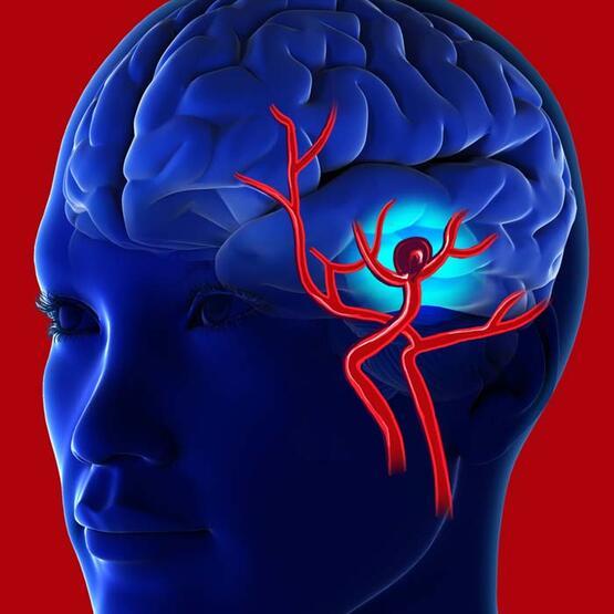 Beyin anevrizması nedir? Beyin kanamasına yol açıyor! Bu 4 kritik belirtiye dikkat