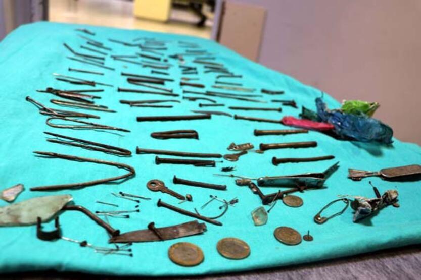 Midesinden çivi, bıçak, tırnak makası gibi 158 parça metal çıkarıldı