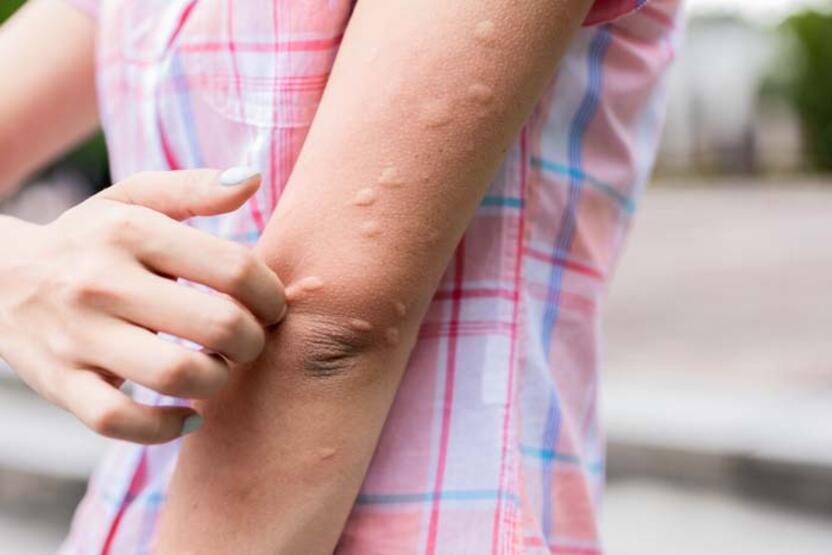 Sivrisinek ısırığı sonrası görülen ateşe dikkat! 5 farklı bulaşıcı hastalığa neden oluyor