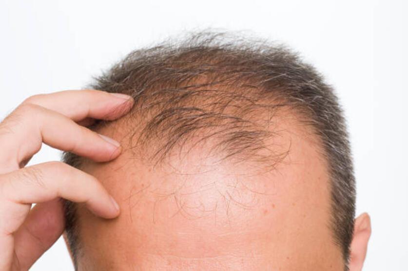 Saç dökülmesi yaşayan erkekler bunları tüketebilir