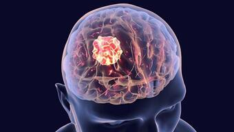 Beyin tümörünün 6 erken belirtisi! Cep telefonlarına dikkat! Beyin tümörüne neden oluyor!