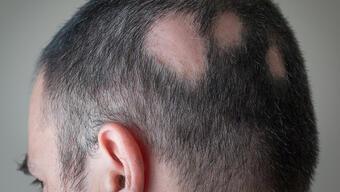 Saçkıran hastalığının görülme sıklığı nedir?