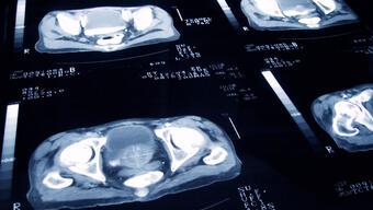 Prostat kanseri: Yeni bir deney, radyoterapi dozlarının büyük ölçüde azaltılabileceğini ortaya koydu