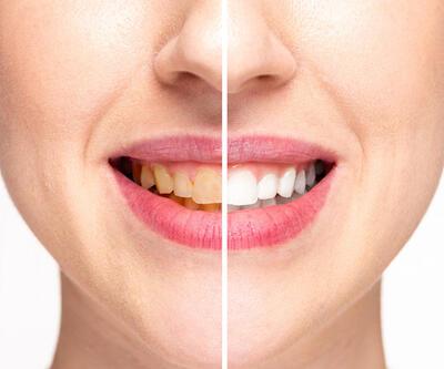 Dişlerin sararması önlenebilir mi | Video