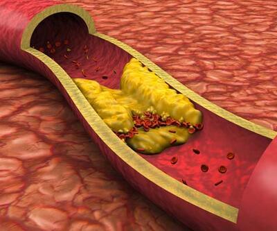 Kolesterol artışı safra kesesi taşı riskini de artırıyor