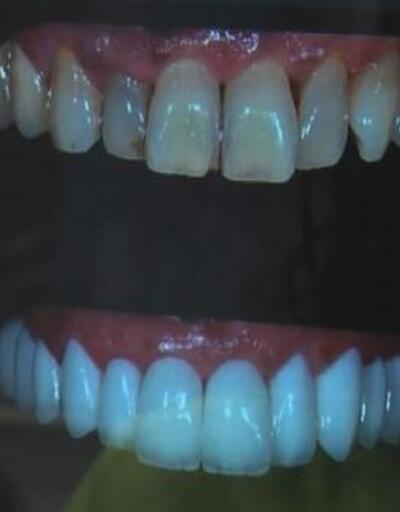 Porselen diş çılgınlığı 18 yaş altına kadar indi, diş hekimleri uyardı