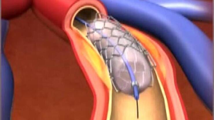 Kalp damarda eriyen stent dönemi