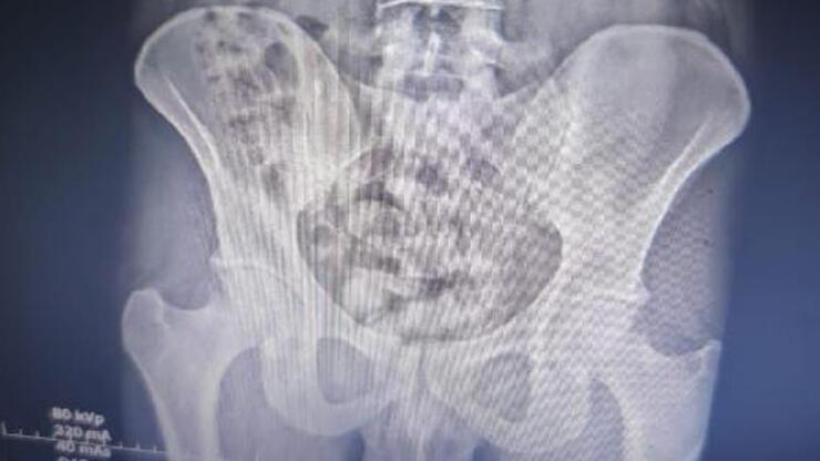 Röntgen filminde midesinde 25 kapsül uyuştucu ile yakalandı