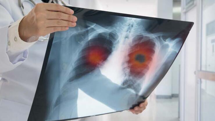 ‘Akciğer kanserinin gençlerde görülme sıklığı arttı’