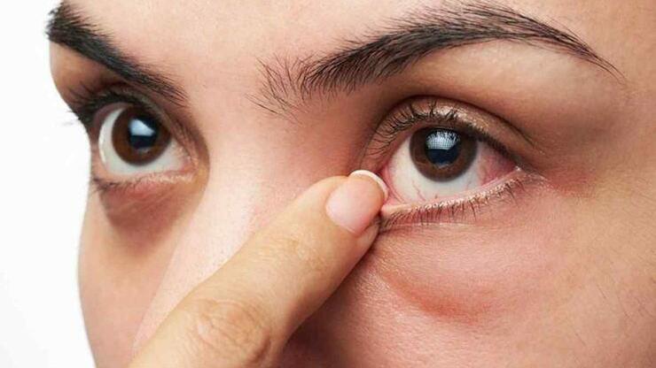 Göz enfeksiyonuna ne iyi gelir, neden olur? - Sağlık Haberleri