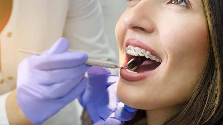 Diş boşlukları ortodontik tedavi ile kapatılabilir