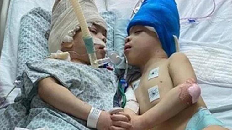Yapışık ikizler 27 saatlik operasyonla ayrıldı! Brezilya'daki ameliyat Londra'dan yönlendirildi