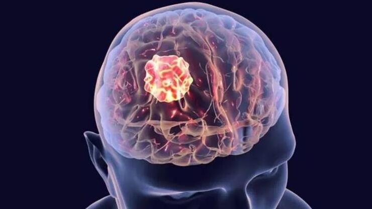 Uzmanı uyardı: Belirti vermeden ilerleyen beyin tümörlerine dikkat