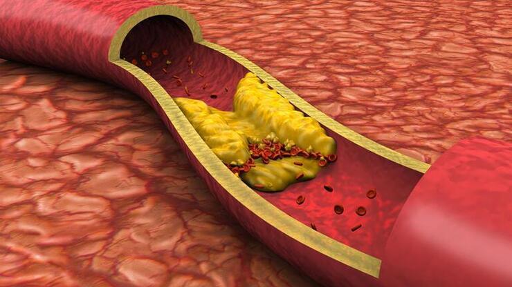 HDL kolesterol yüksekliği nedir, neden olur? 
