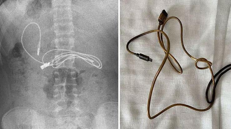 Elazığ'da doktorları şaşırtan olay! Midesinden telefon kablosu çıktı